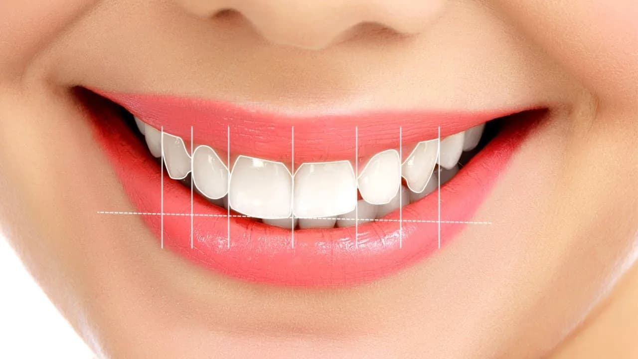Gülüş Tasarımı Nedir ve Nasıl Planlanır?
