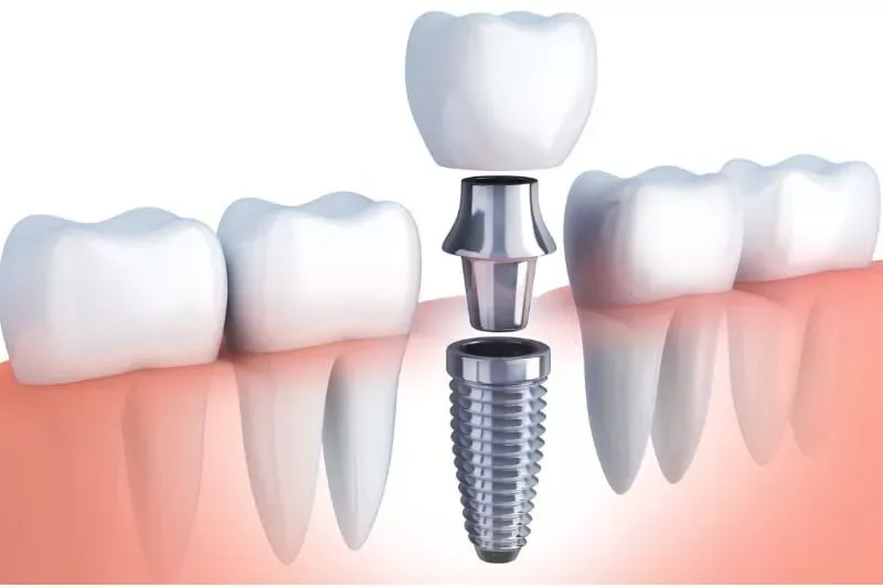 Dental İmplant