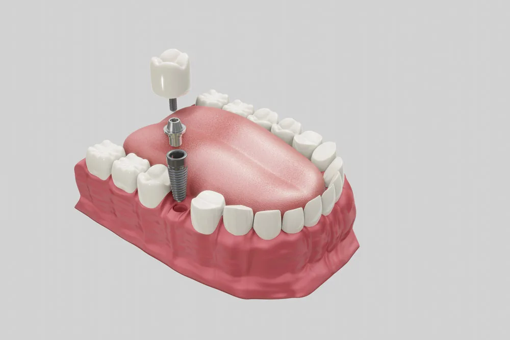 Alt çenede dental implant ve kronu gösteren üç boyutlu çizim