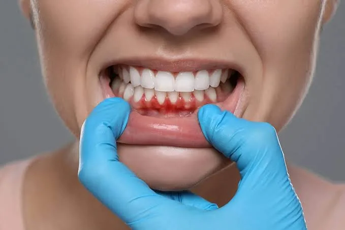 Girne’de Periodontal Tedaviler